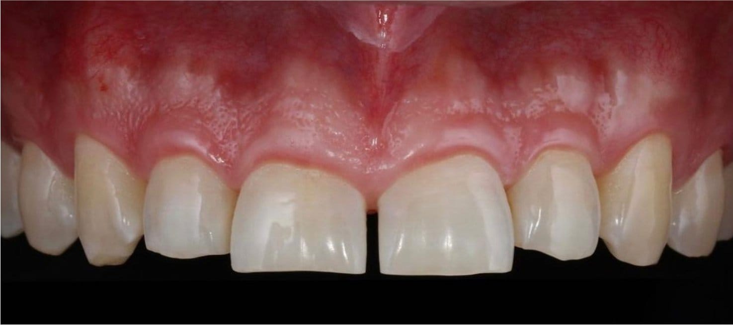 1-Antes Affordable Dental Care in Brazil for U.S. Patients – SpeedDentalCareBrazil.com – Fortaleza