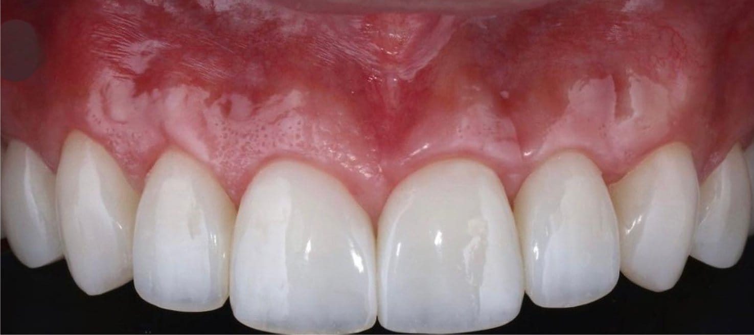 1-Depois Affordable Dental Care in Brazil for U.S. Patients – SpeedDentalCareBrazil.com – Fortaleza
