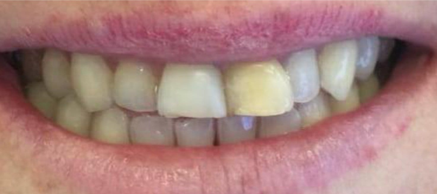 2-Antes Affordable Dental Care in Brazil for U.S. Patients – SpeedDentalCareBrazil.com – Fortaleza