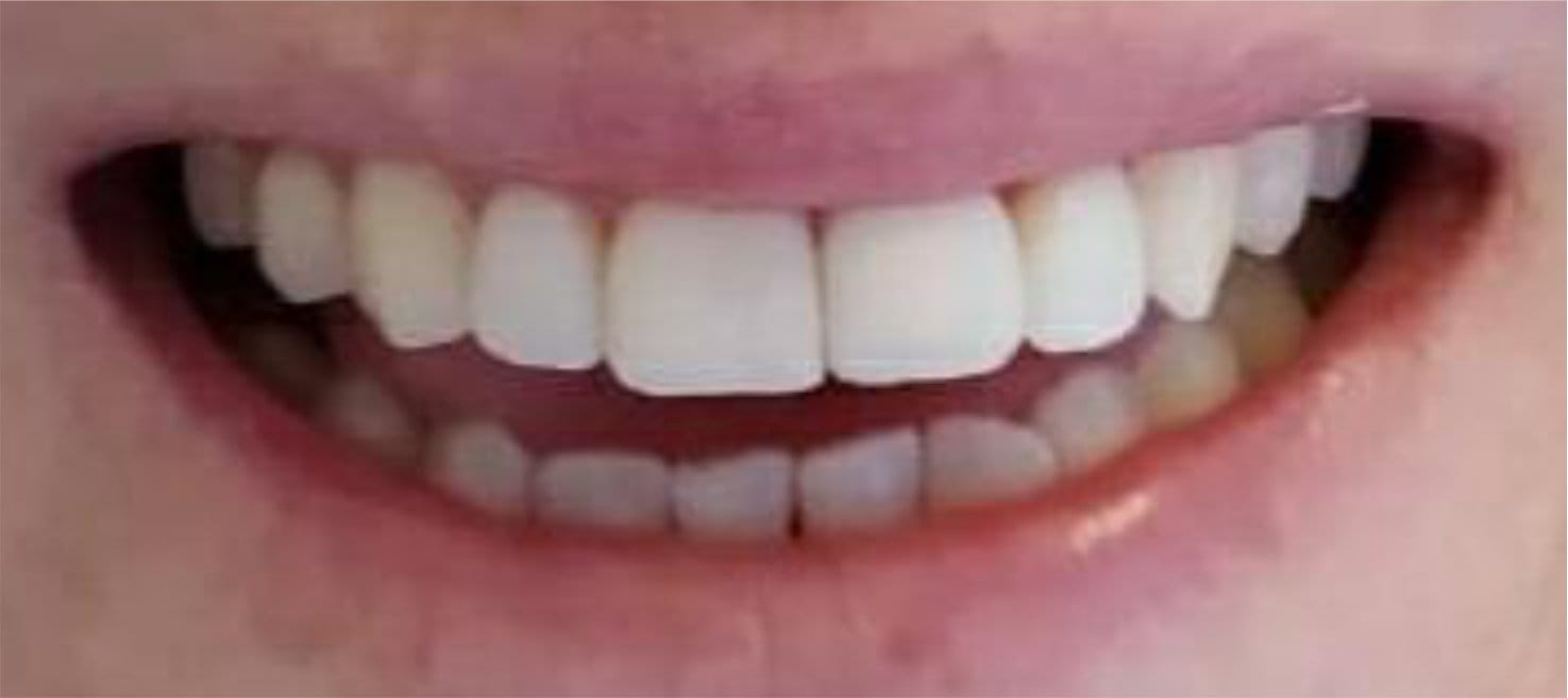 2-Depois Affordable Dental Care in Brazil for U.S. Patients – SpeedDentalCareBrazil.com – Fortaleza