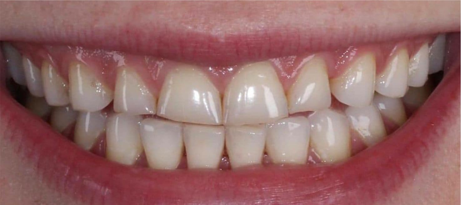 3-Antes Affordable Dental Care in Brazil for U.S. Patients – SpeedDentalCareBrazil.com – Fortaleza