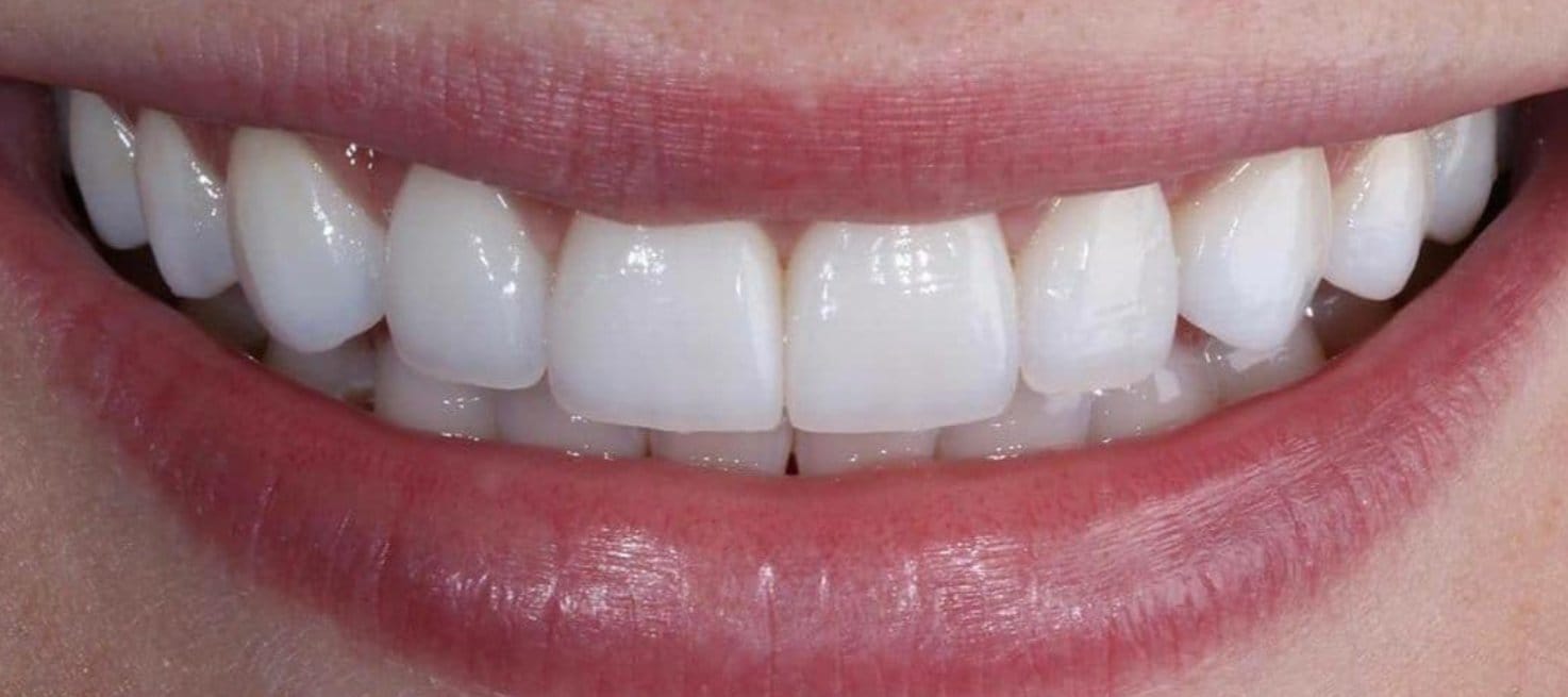 3-Depois Affordable Dental Care in Brazil for U.S. Patients – SpeedDentalCareBrazil.com – Fortaleza