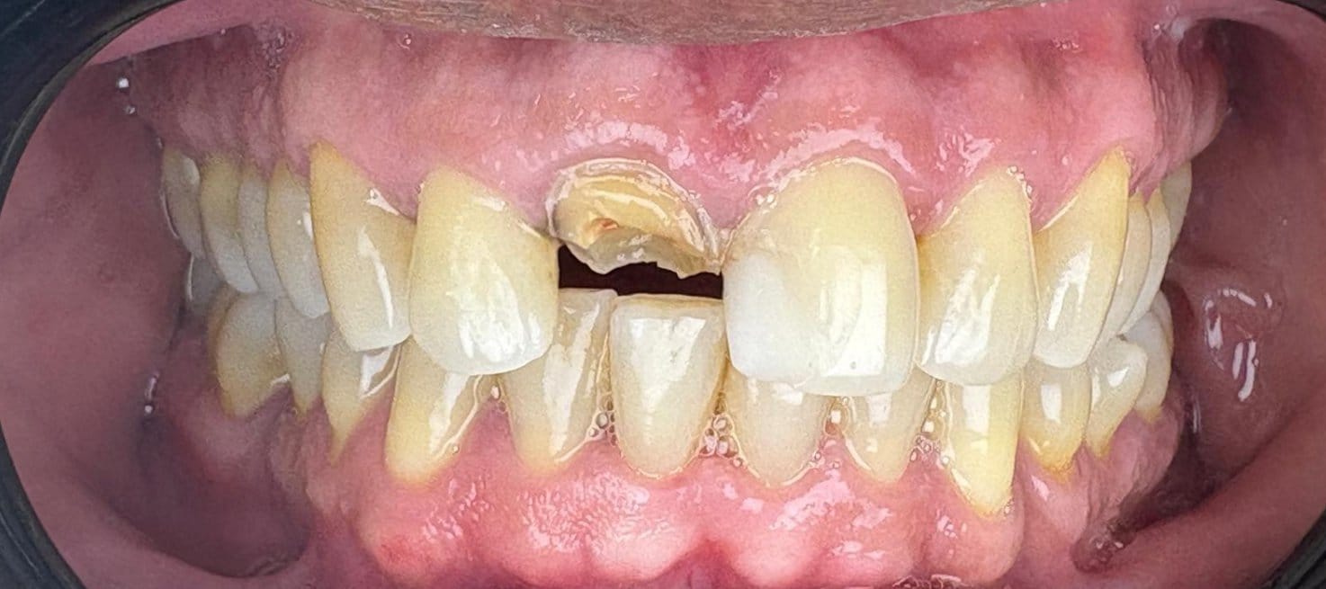 4-Antes Affordable Dental Care in Brazil for U.S. Patients – SpeedDentalCareBrazil.com – Fortaleza