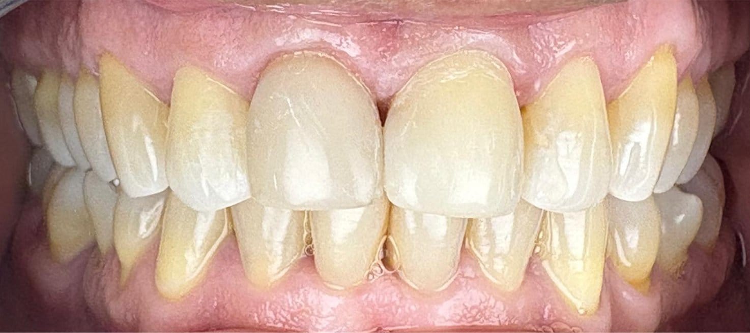 4-Depois Affordable Dental Care in Brazil for U.S. Patients – SpeedDentalCareBrazil.com – Fortaleza