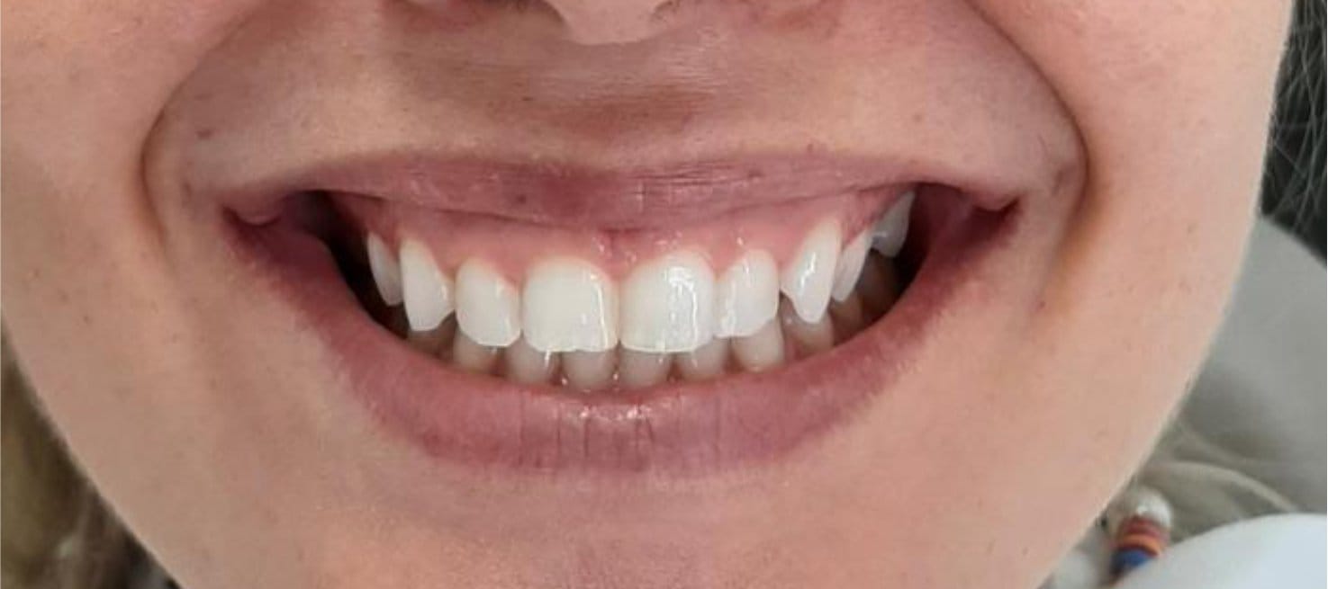 5-Antes Affordable Dental Care in Brazil for U.S. Patients – SpeedDentalCareBrazil.com – Fortaleza