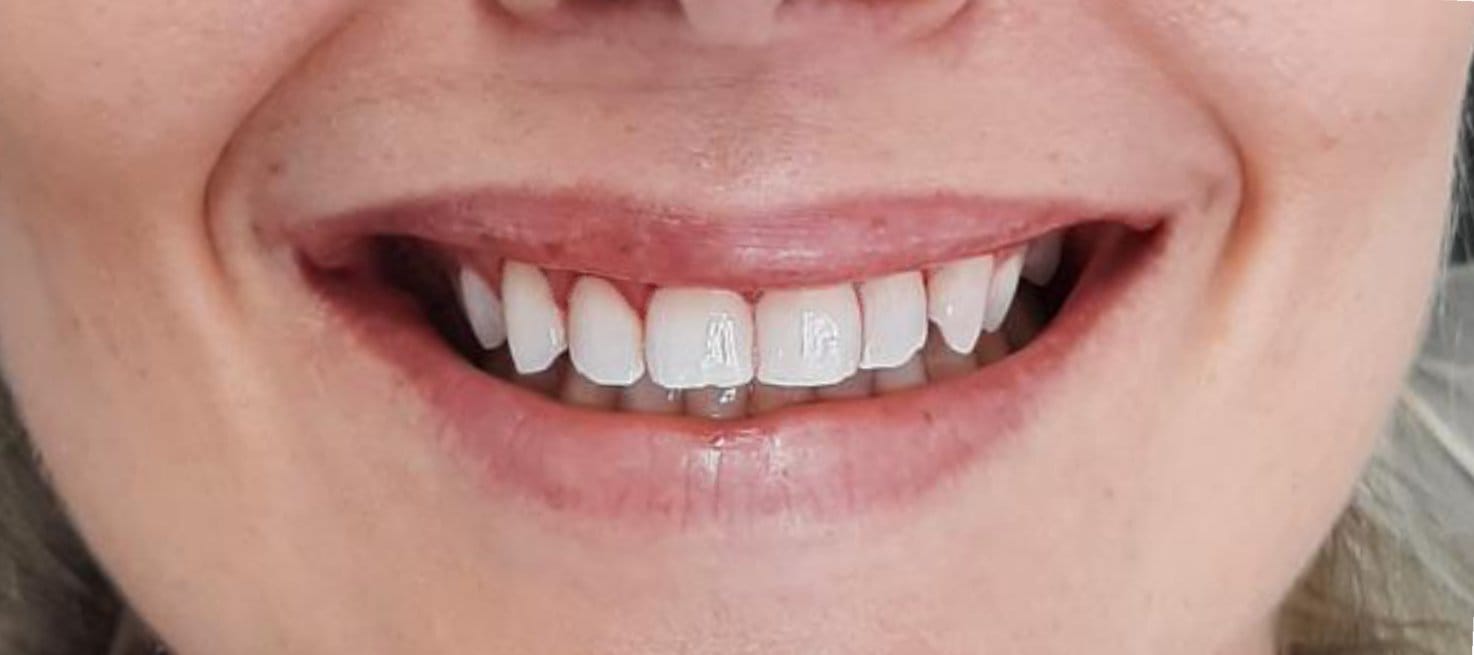 5-Depois Affordable Dental Care in Brazil for U.S. Patients – SpeedDentalCareBrazil.com – Fortaleza