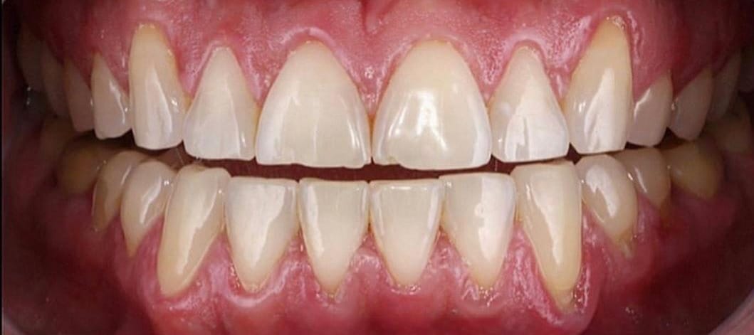 antes Affordable Dental Care in Brazil for U.S. Patients – SpeedDentalCareBrazil.com – Fortaleza