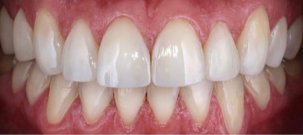 depois2 Affordable Dental Care in Brazil for U.S. Patients – SpeedDentalCareBrazil.com – Fortaleza